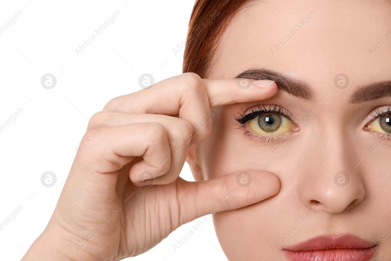 Photo of Woman with yellow eyes on white background, closeup. Symptom of hepatitis