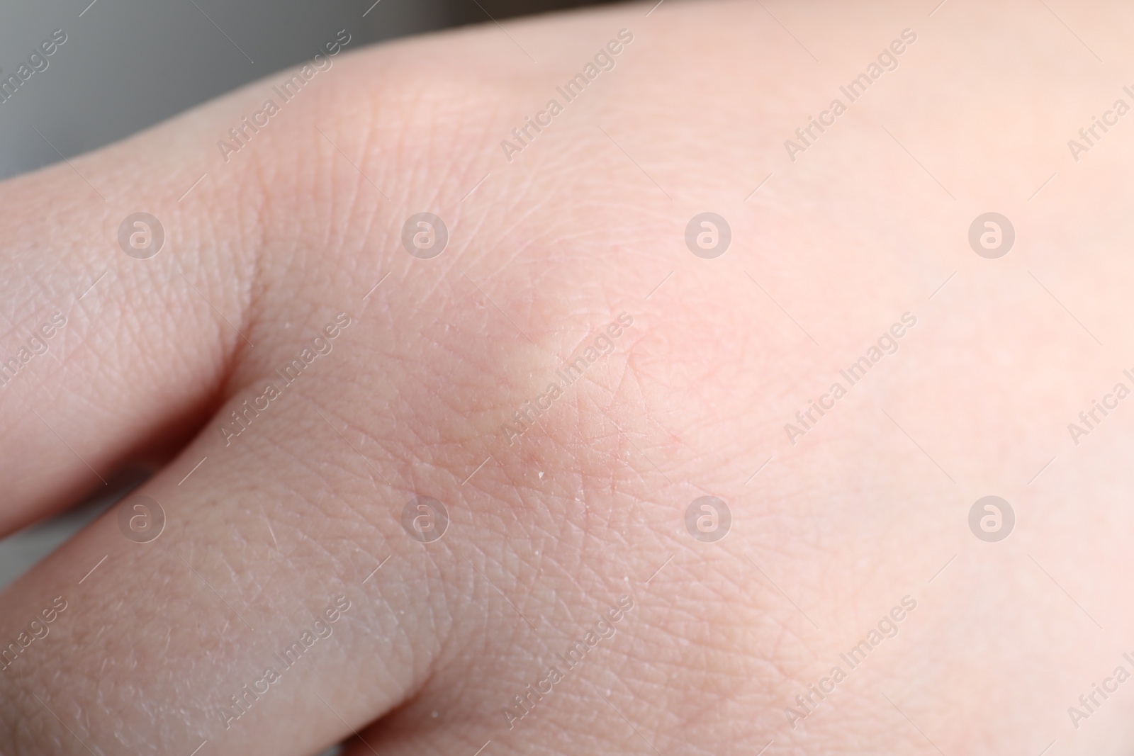 Photo of Woman with dry skin on hand, closeup