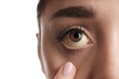 Photo of Woman checking her health condition on white background, closeup. Yellow eyes as symptom of problems with liver