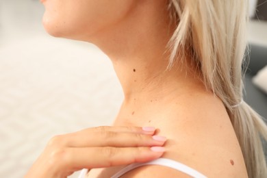 Photo of Closeup view of woman`s body with birthmarks indoors