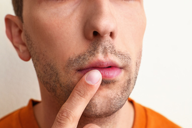 Image of Young man with cold sore applying cream on lips against white background, closeup