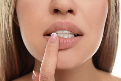 Image of Young woman with cold sore applying cream on lips, closeup