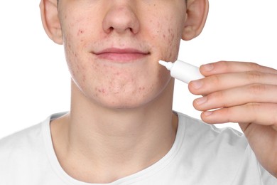 Photo of Young man with acne problem applying cosmetic product onto his skin on white background, closeup