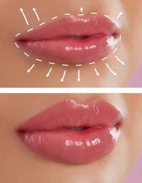 Image of Collage with photos of young woman before and after lips augmentation procedure, closeup