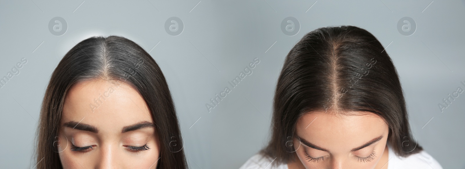 Image of Woman before and after hair treatment with high frequency darsonval device on grey background, closeup. Collage of photos