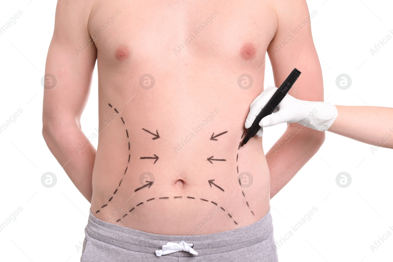 Photo of Doctor drawing lines on man's stomach with marker against white background