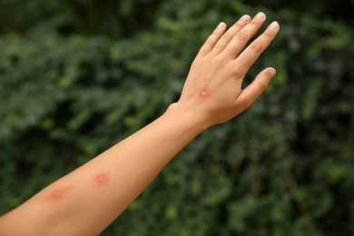 Woman with insect bites on arm in park, closeup