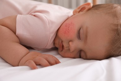Image of Cute little baby with allergic redness sleeping on bed, closeup