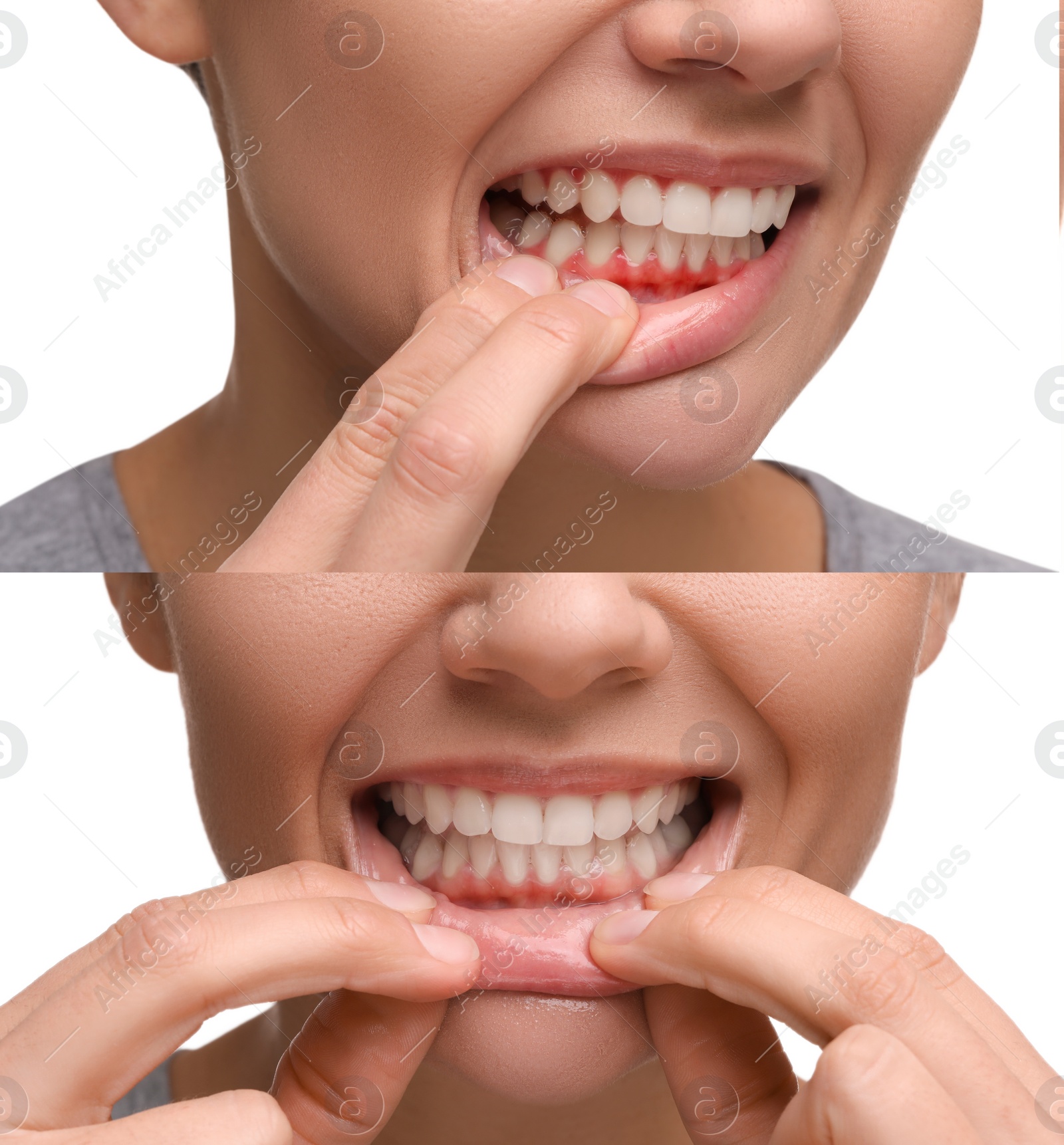 Image of Woman showing gum before and after treatment on white background, collage of photos