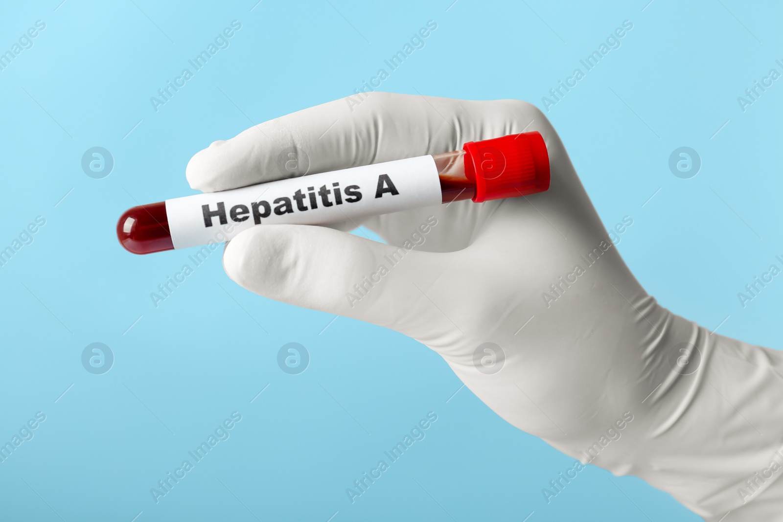 Photo of Scientist holding tube with blood sample and label Hepatitis A on light blue background, closeup