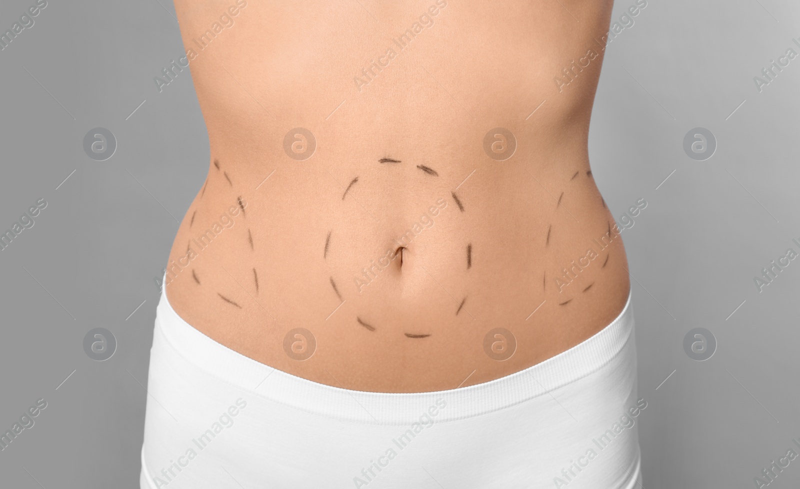 Photo of Young woman with marks on body for cosmetic surgery operation against grey background, closeup