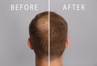 Man with hair loss problem before and after treatment on grey background, collage. Visiting trichologist