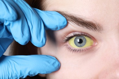 Doctor checking woman with yellow eyes, closeup. Symptom of hepatitis