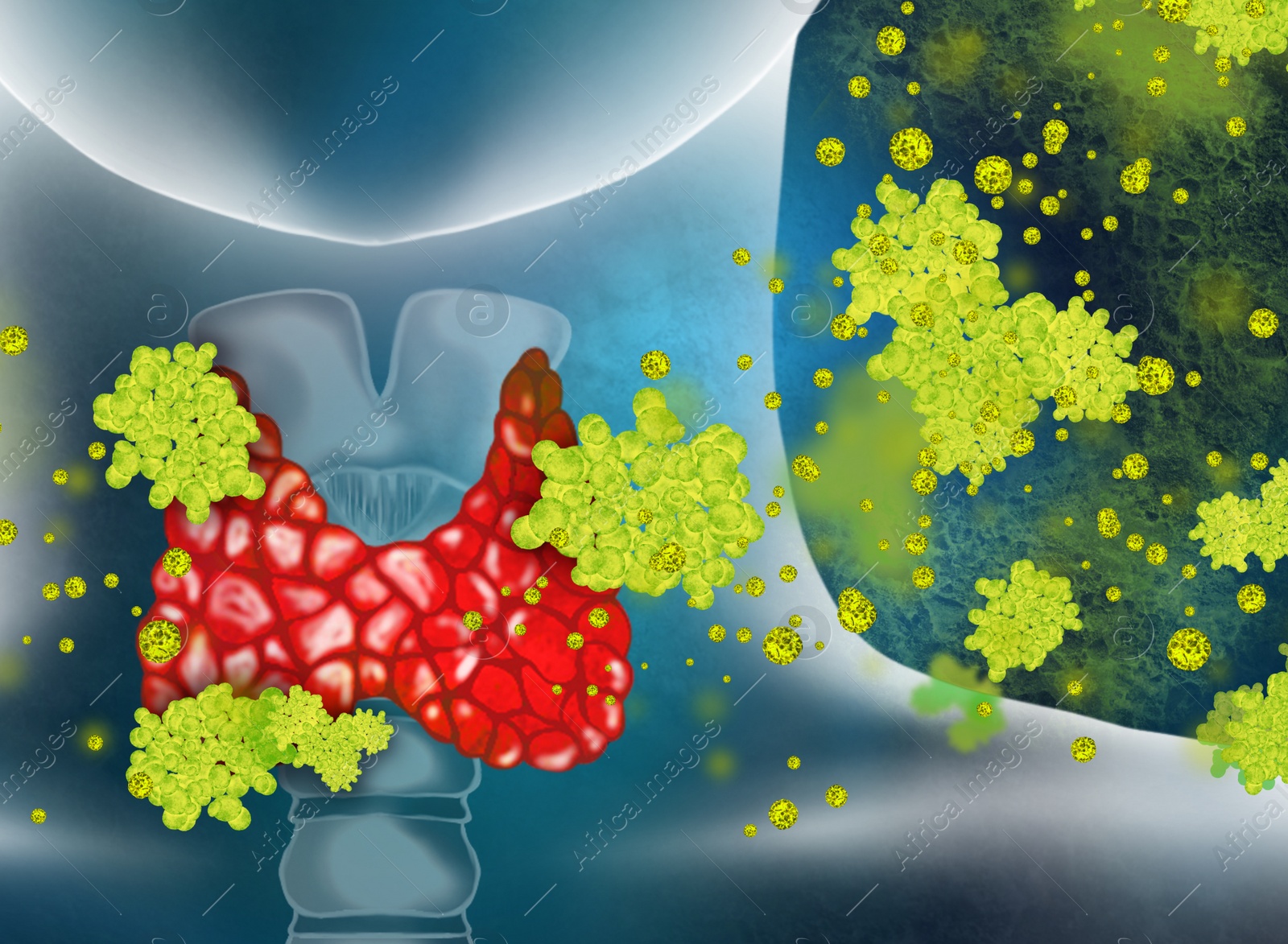 Illustration of Illustration of human thyroid cancer on color background