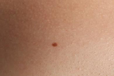 Closeup view of woman's body with birthmark
