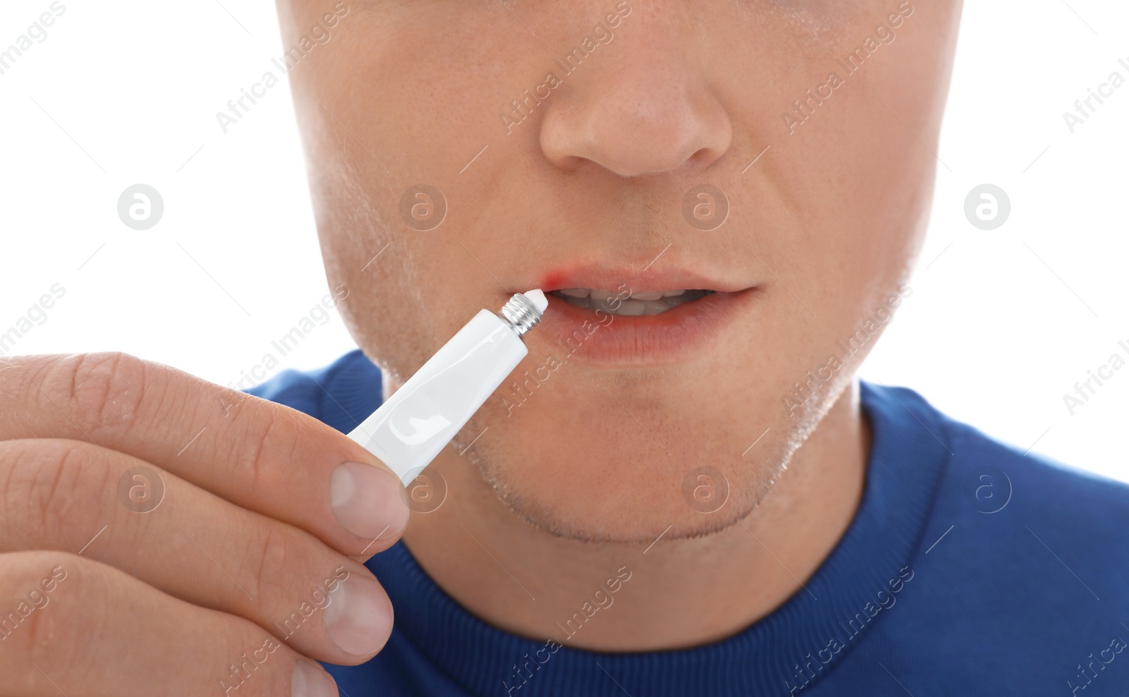 Photo of Man with cold sore applying cream on lips against white background, closeup