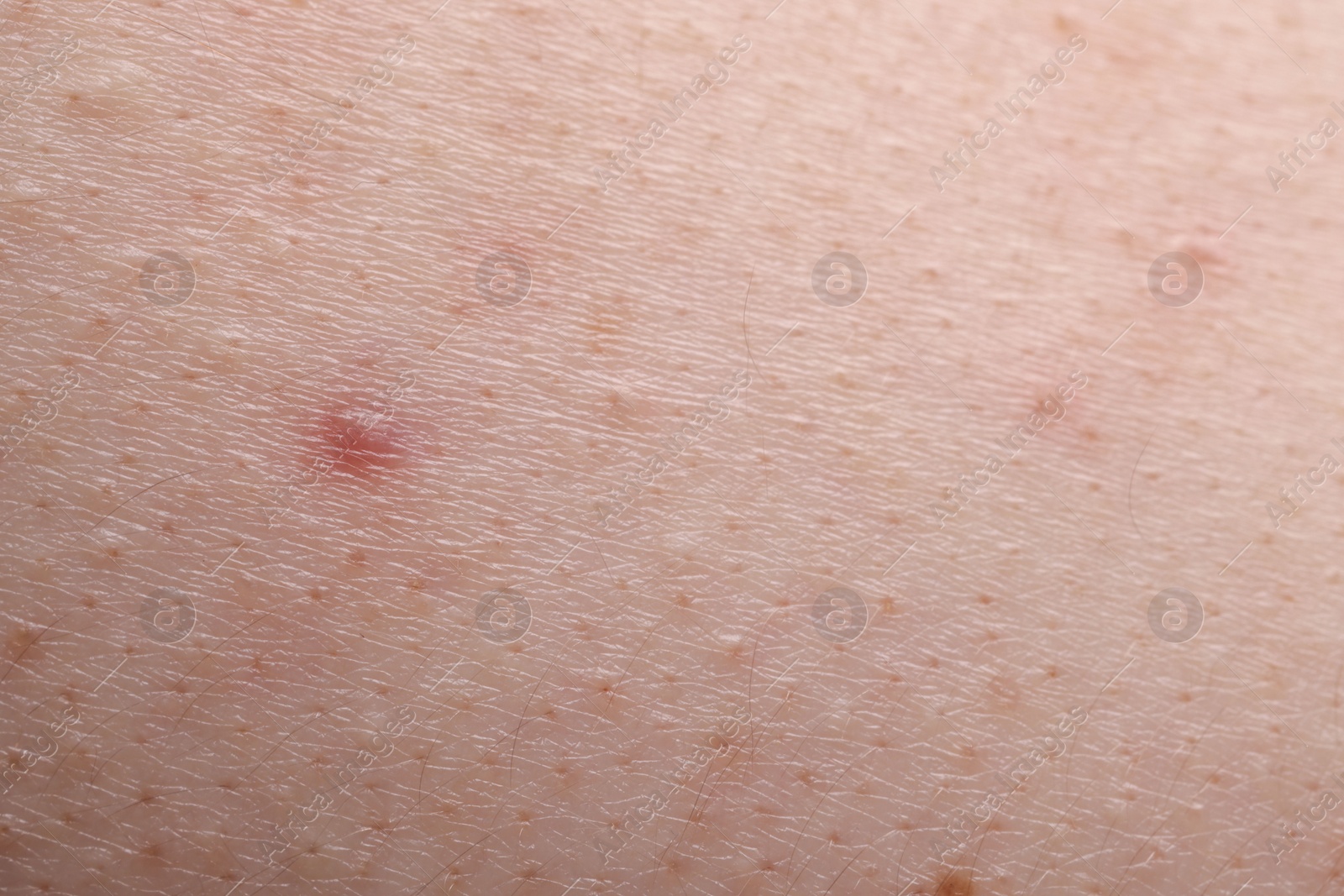 Photo of Young person with acne problem, closeup view of skin