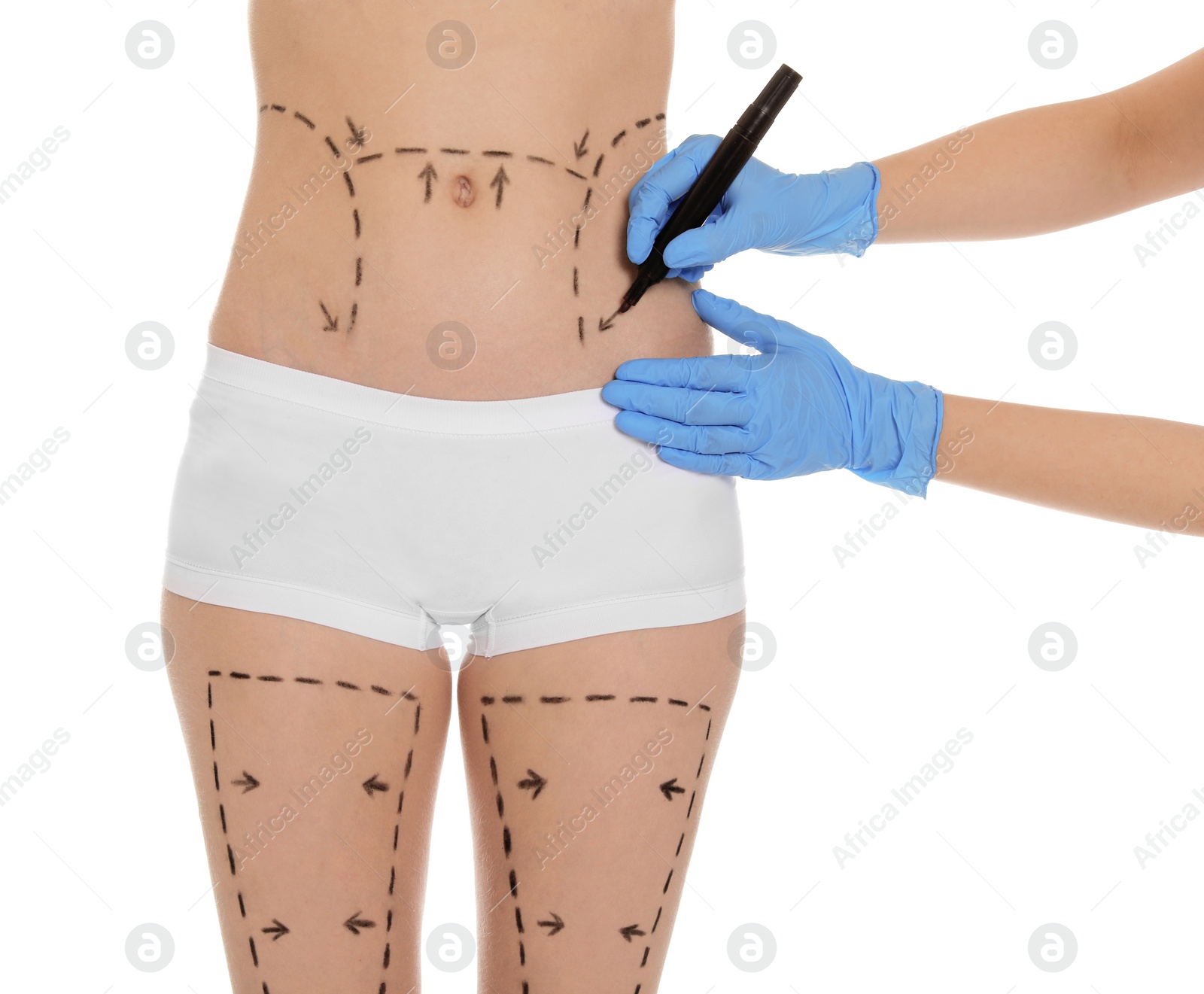 Photo of Doctor drawing marks on female belly for cosmetic surgery operation against white background