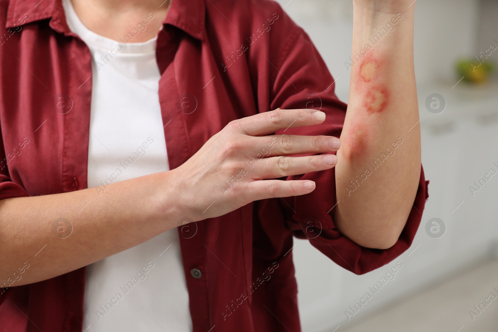 Photo of Woman with burns on her hand in kitchen, closeup