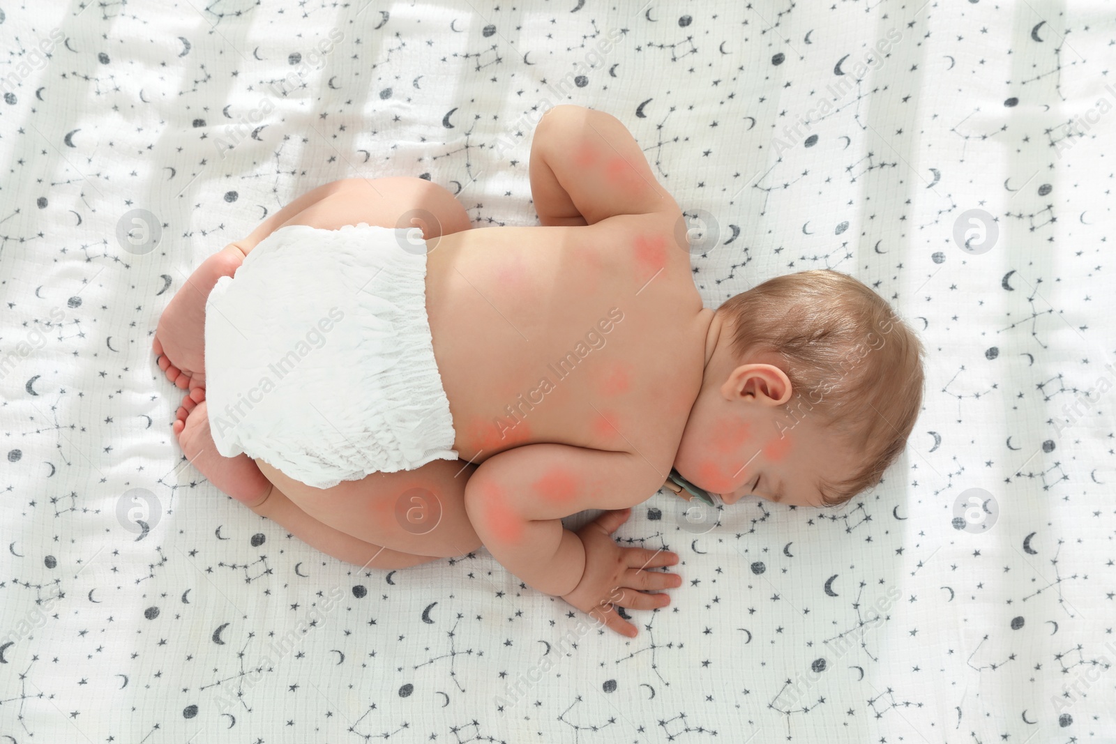 Image of Cute little baby with allergic redness sleeping on soft bed, top view