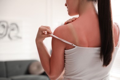 Photo of Woman with sunburned skin at home, closeup