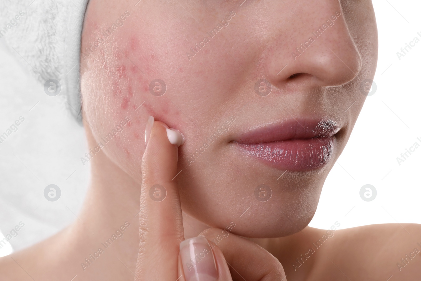 Photo of Young woman with acne problem applying cosmetic product onto her skin on white background, closeup