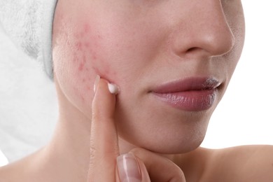 Young woman with acne problem applying cosmetic product onto her skin on white background, closeup