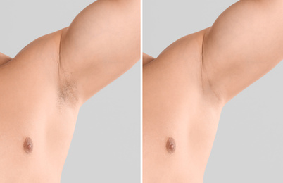 Image of Collage of man showing armpit before and after epilation on light grey background, closeup 