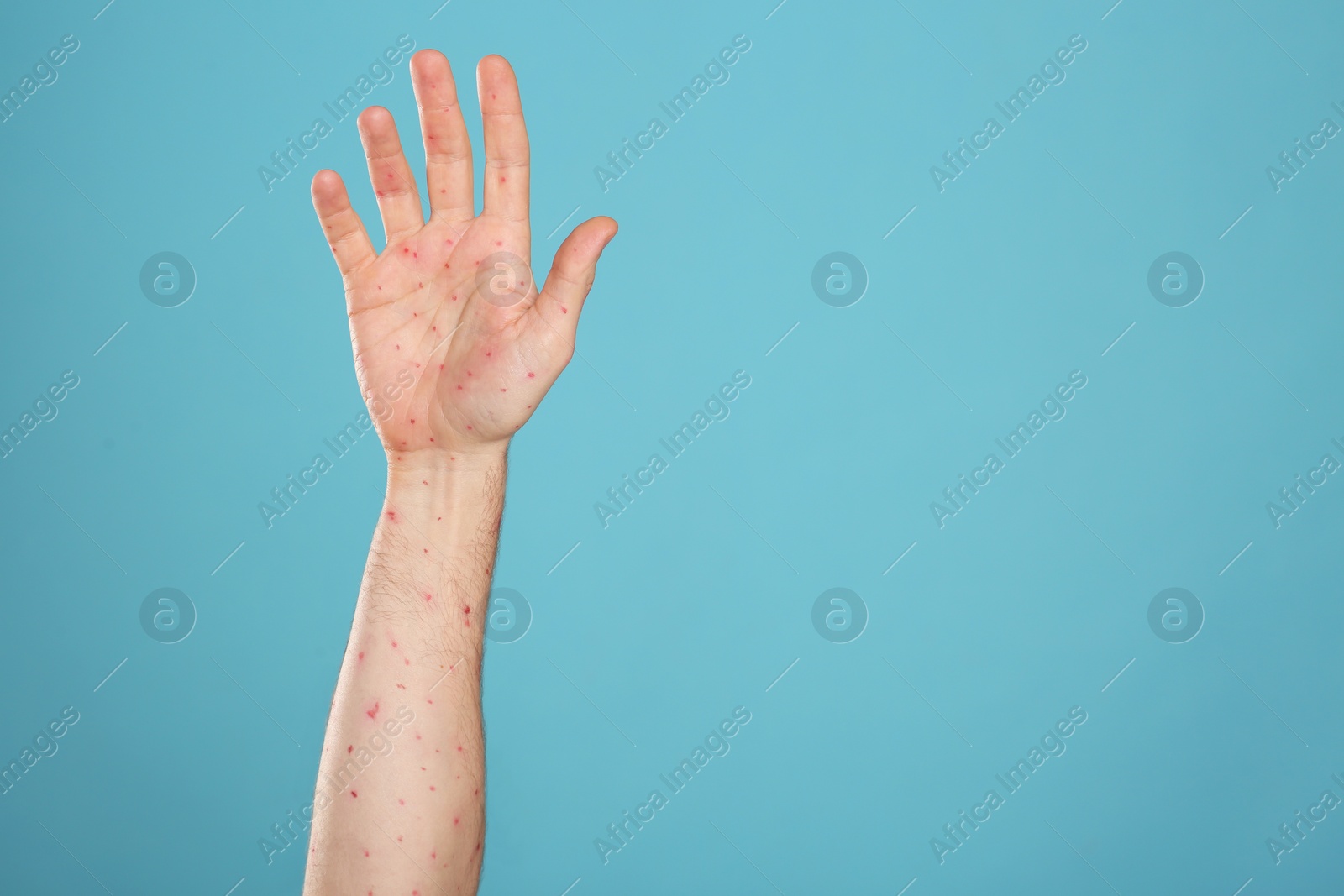 Photo of Man with rash suffering from monkeypox virus on light blue background, closeup. Space for text