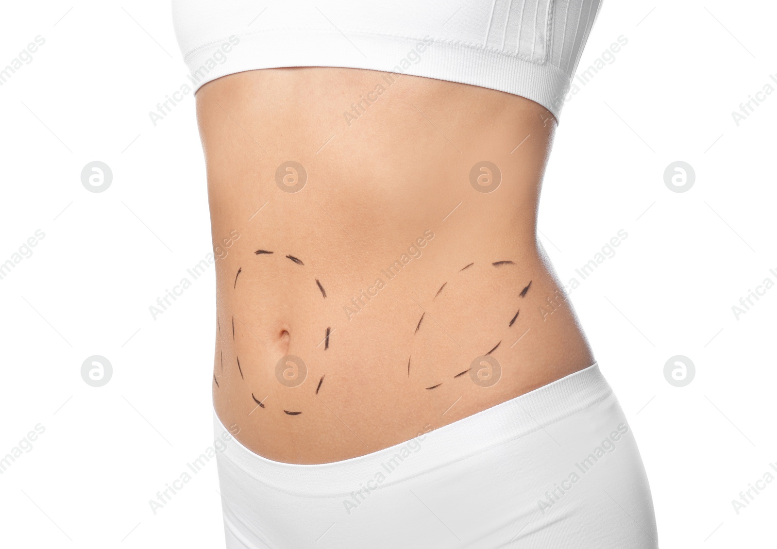 Photo of Young woman with marks on body for cosmetic surgery operation against white background, closeup