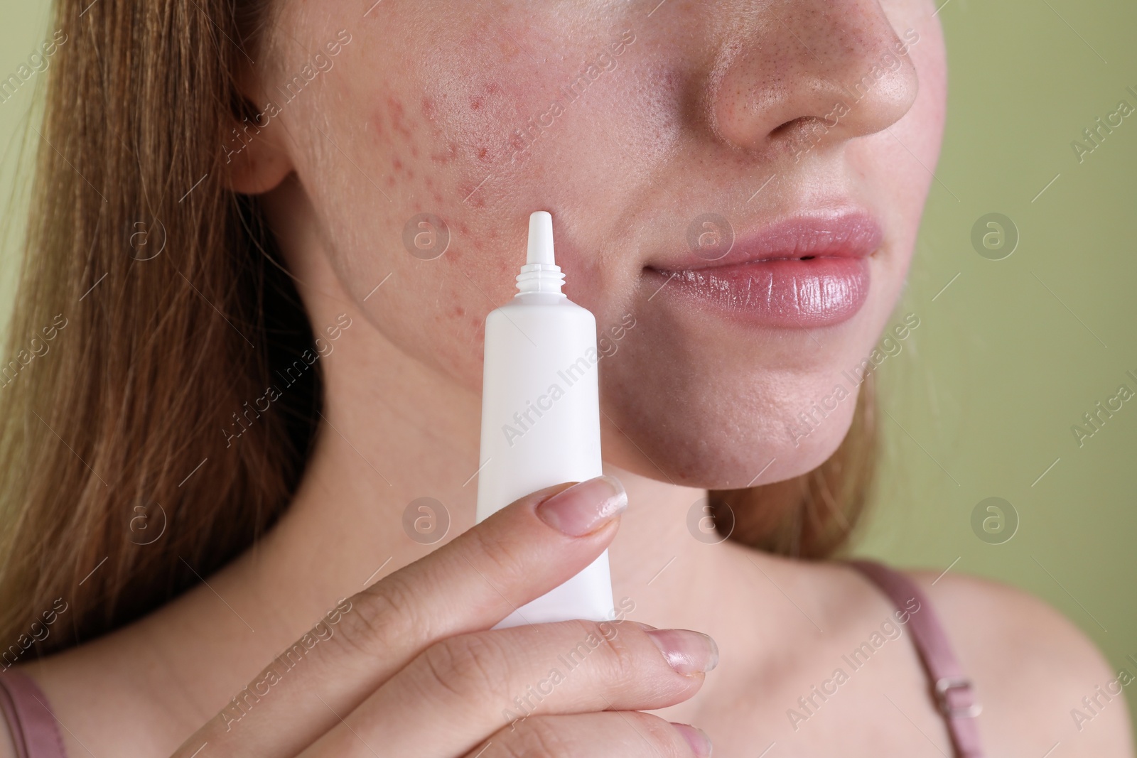 Photo of Young woman with acne problem applying cosmetic product onto her skin on olive background, closeup