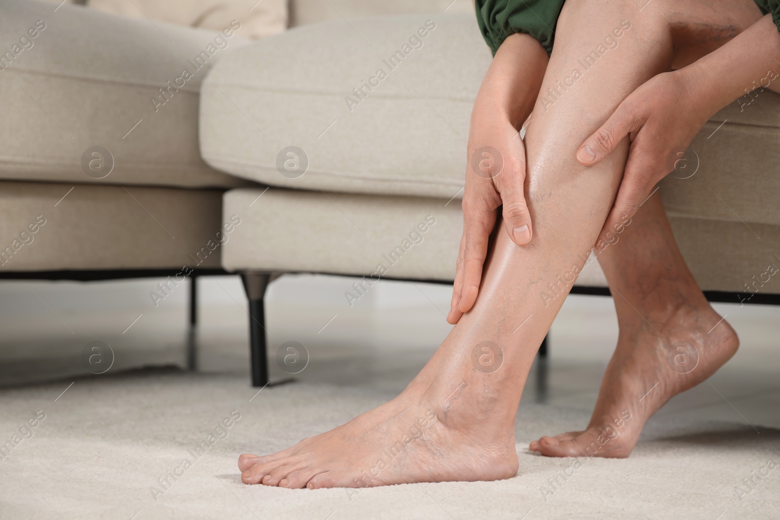 Photo of Barefoot woman with varicose veins on sofa in room, closeup