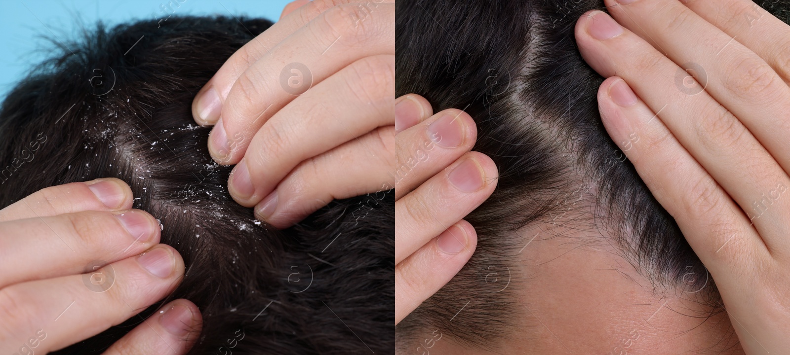Image of Man showing hair before and after dandruff treatment, collage