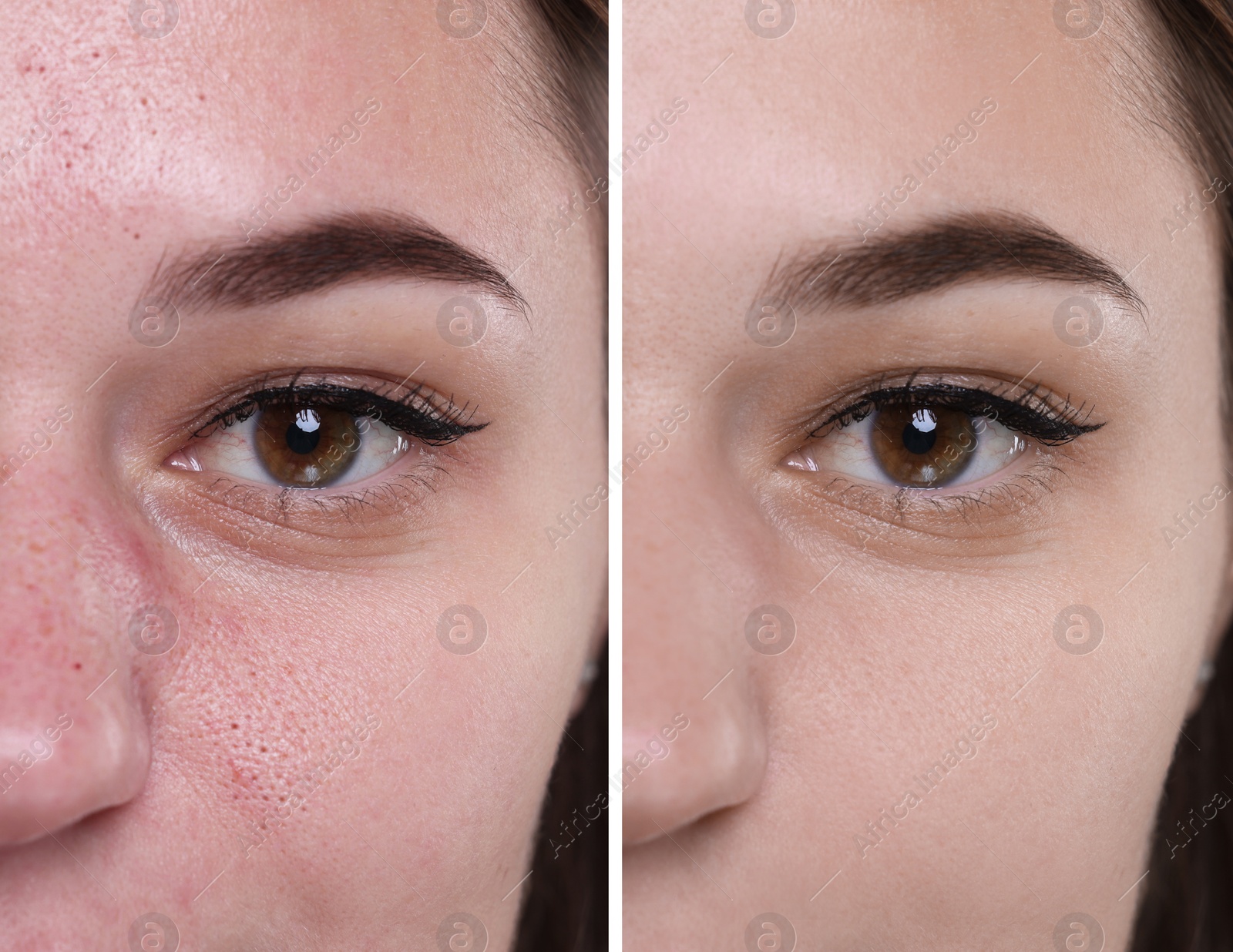 Image of Blackhead treatment, before and after. Collage with photos of woman, closeup view