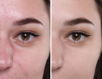 Image of Blackhead treatment, before and after. Collage with photos of woman, closeup view