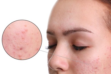 Dermatology. Woman with skin problem on white background, closeup. Zoomed area showing acne