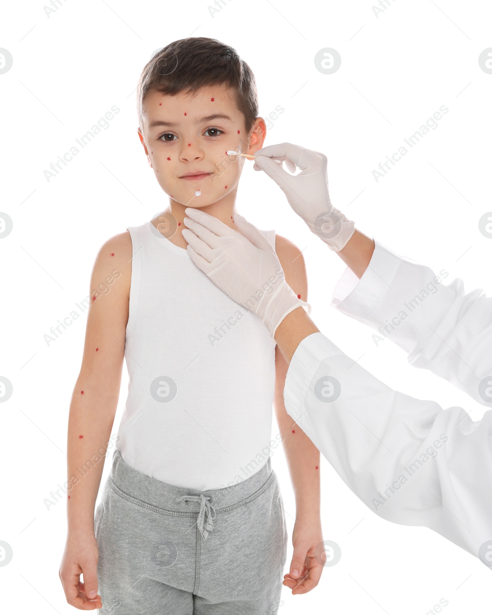 Photo of Doctor applying cream onto skin of little boy with chickenpox on white background. Varicella zoster virus