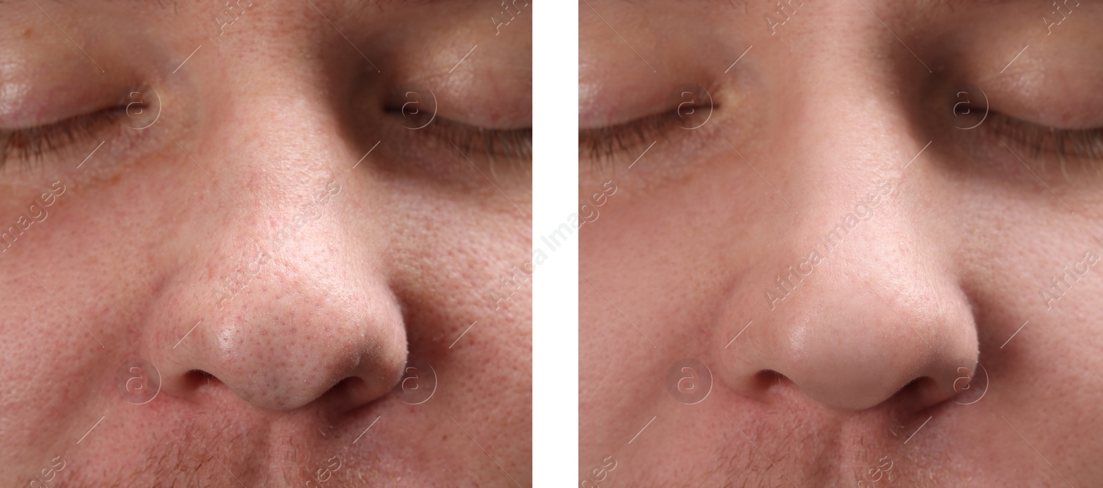 Image of Photos of man before and after acne treatment, closeup. Collage showing affected and healthy skin