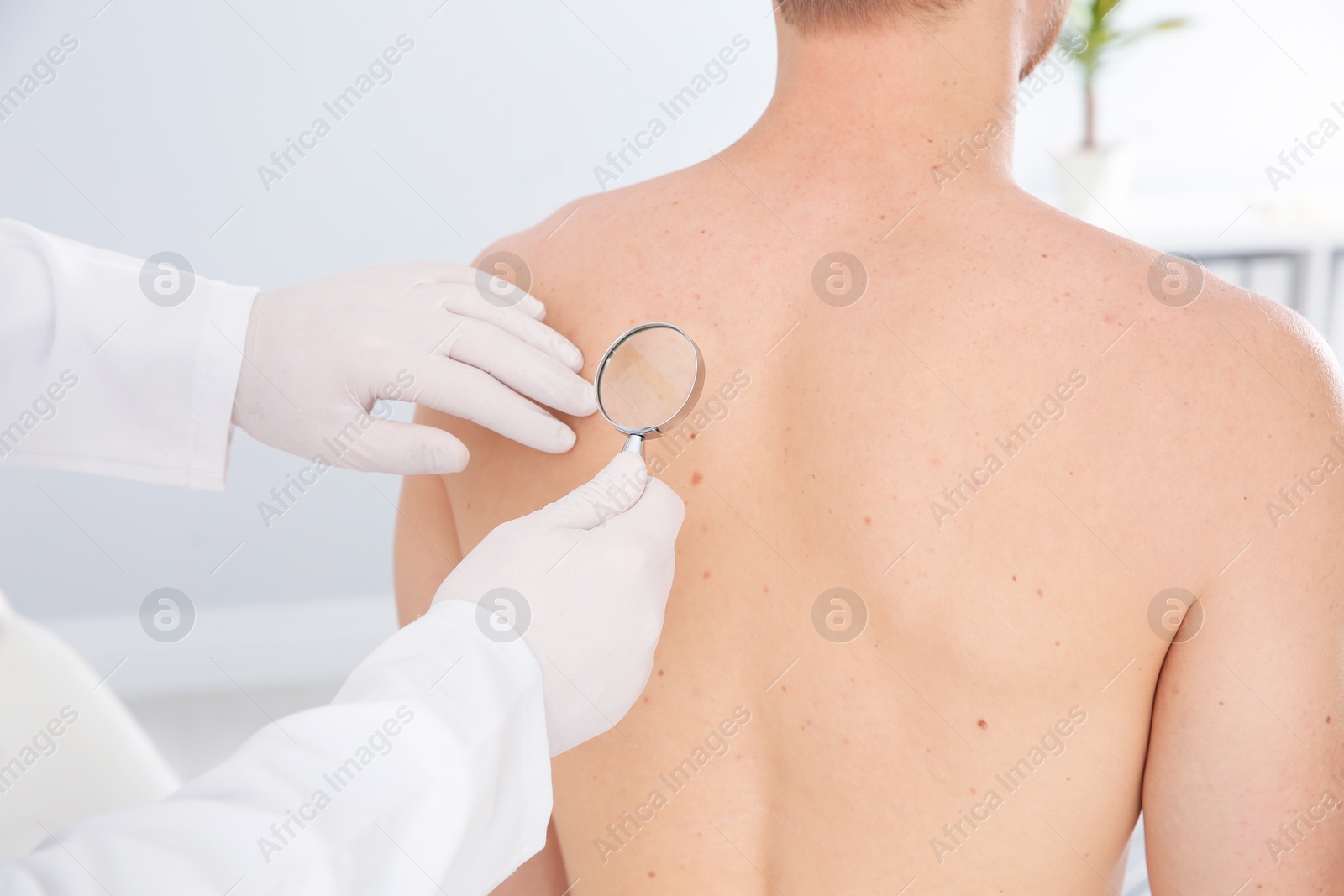 Photo of Dermatologist examining patient's birthmark with magnifying glass in clinic, closeup