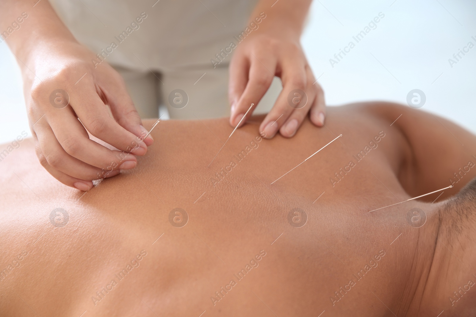 Photo of Young man undergoing acupuncture treatment in salon, closeup