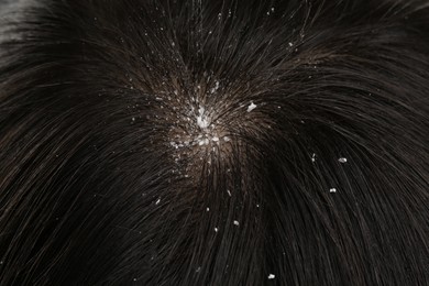 Photo of Woman with dandruff in her dark hair, closeup view