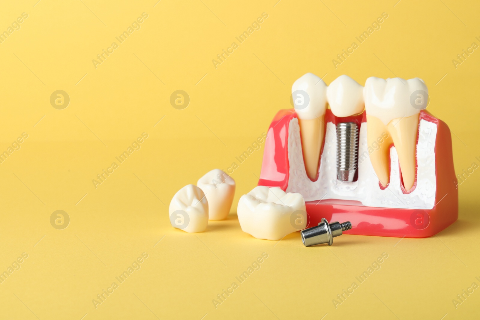 Photo of Educational model of gum with dental implant between teeth on yellow background. Space for text