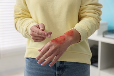 Photo of Woman applying healing cream onto burned hand indoors, closeup