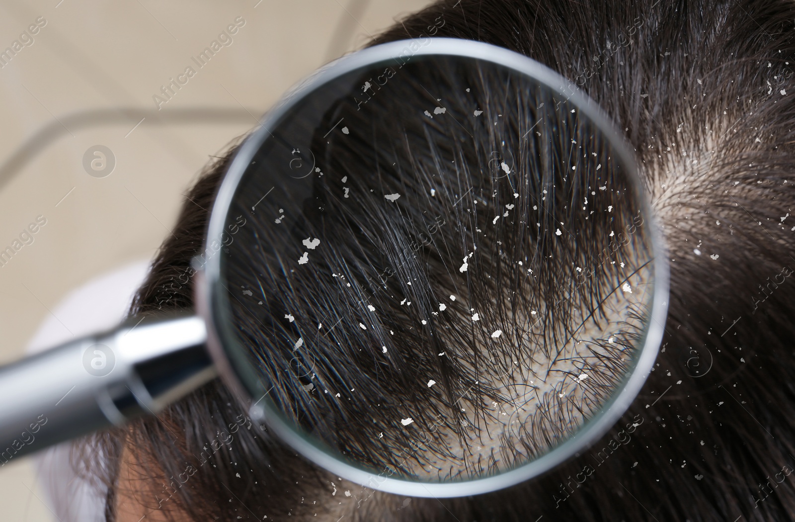 Image of Closeup of woman with dandruff in her hair, view through magnifying glass