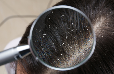 Image of Closeup of woman with dandruff in her hair, view through magnifying glass