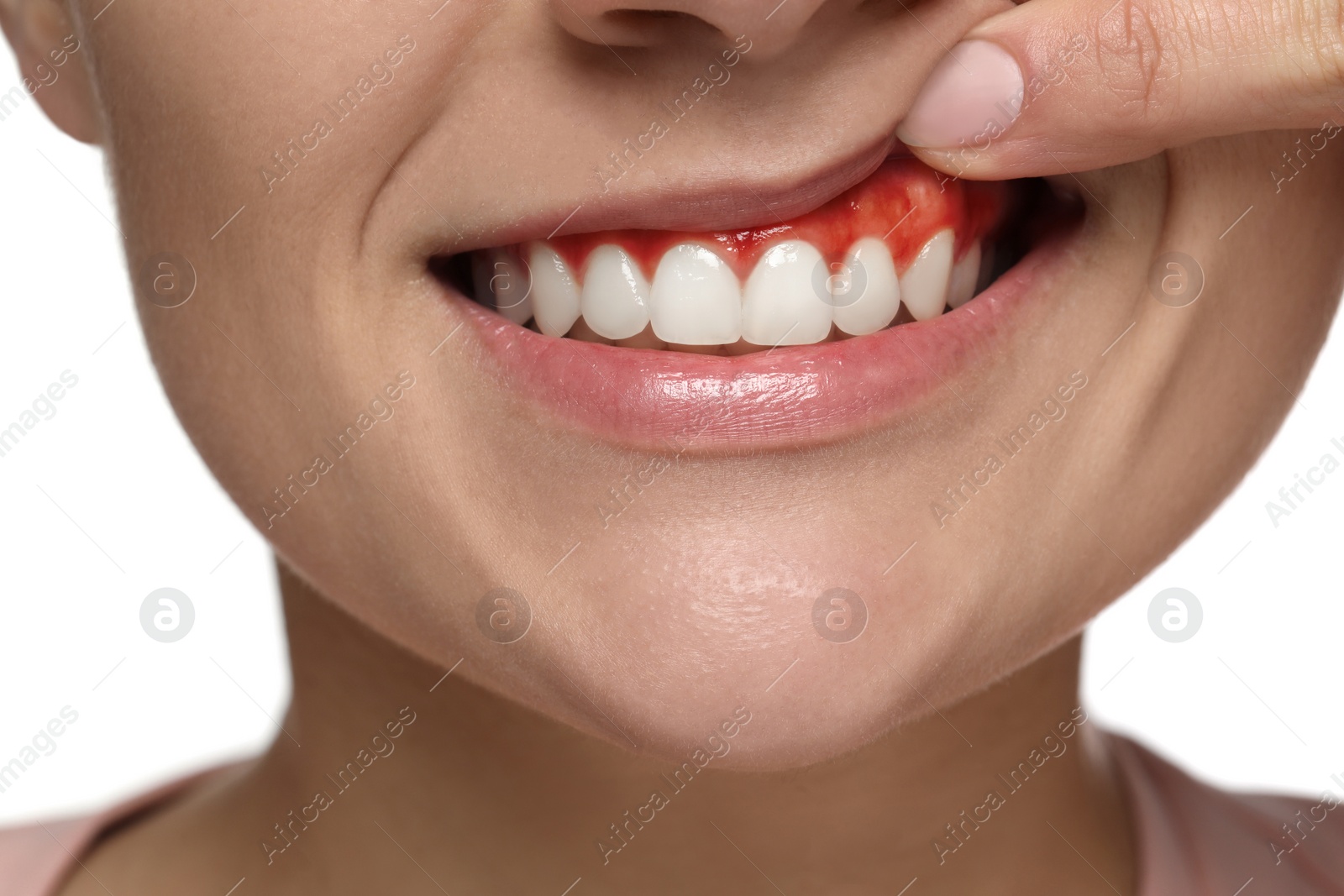 Image of Woman showing inflamed gum on white background, closeup