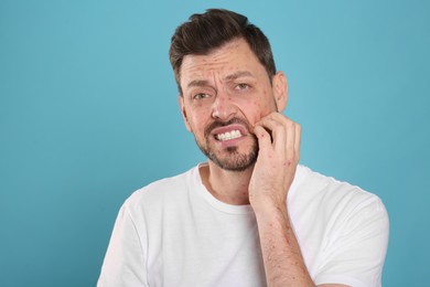 Photo of Man with rash suffering from monkeypox virus on light blue background