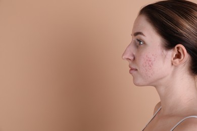 Young woman with acne problem on beige background. Space for text