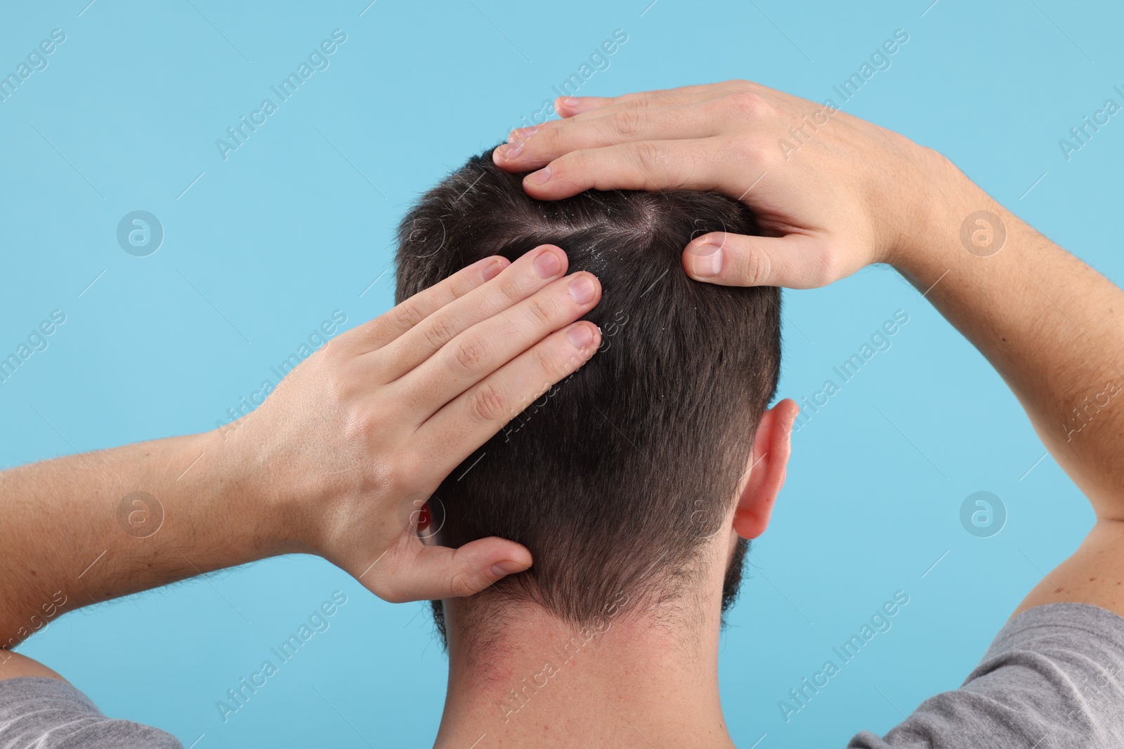 Photo of Man with dandruff in his dark hair on light blue background, back view