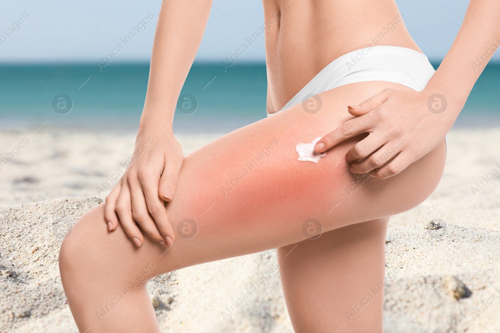 Image of Woman with sunburn on beach, closeup. Skin protection from sun in summer